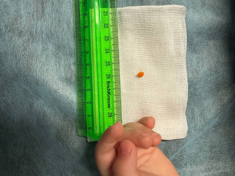 Врачи спасли бегавшего с морковкой во рту мальчика