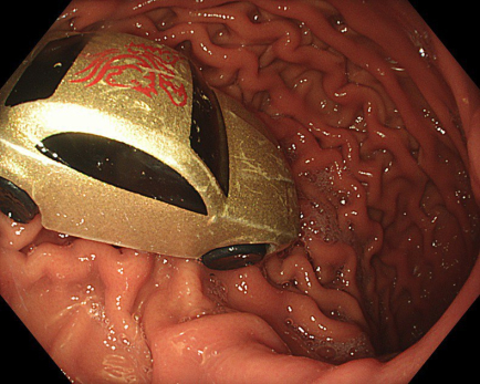 Врачи эвакуировали гоночную машинку, припаркованную в желудке пятилетнего мальчика