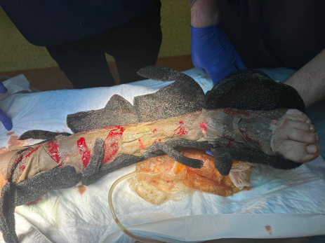 Кожу и мышцы сорвало с тела: получившего страшные раны мальчика залило помоями - фото не для слабонервных
