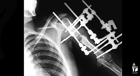 Девушке из Самарской области на 13 сантиметров удлинили руку