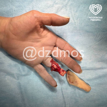 Плюс новая фобия: женщина случайно оторвала себе палец кольцом - фото не для слабонервных