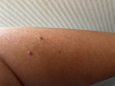 Нужно ли удалять родинки: мнение врачей изменилось