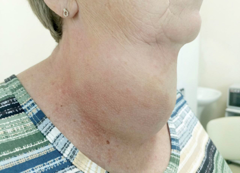 Люди все чаще страдают от гигантских опухолей на шее - это еще не рак, но угроза велика