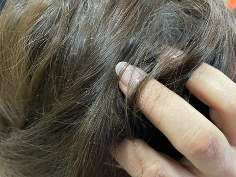 Вши атакуют школьников, а родители не чешутся: врач рассказал, как дети заражаются педикулезом и как распознать болезнь