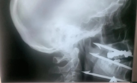 Рыбак ушел под воду и выстрелил себе в лицо из ружья