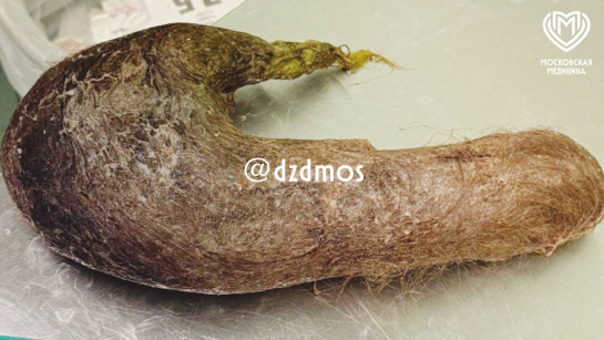 Два года девушка ела свои волосы и вот, к чему это привело