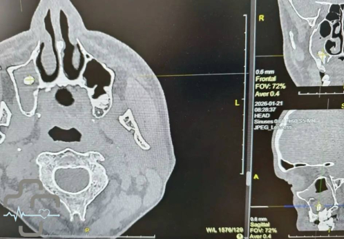 Пациенту извлекли застрявший в неожиданном месте зуб